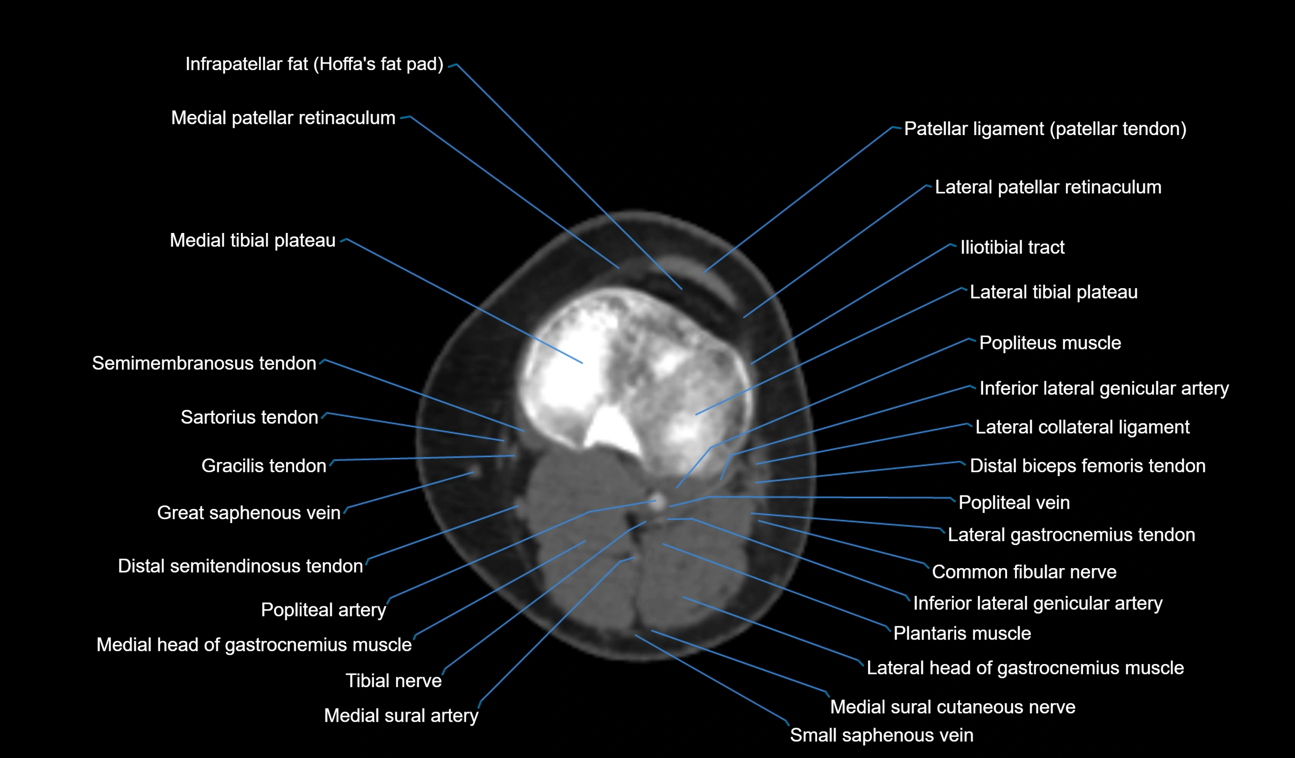 CT knee axial cross sectional anatomy labelled image-00039.webp